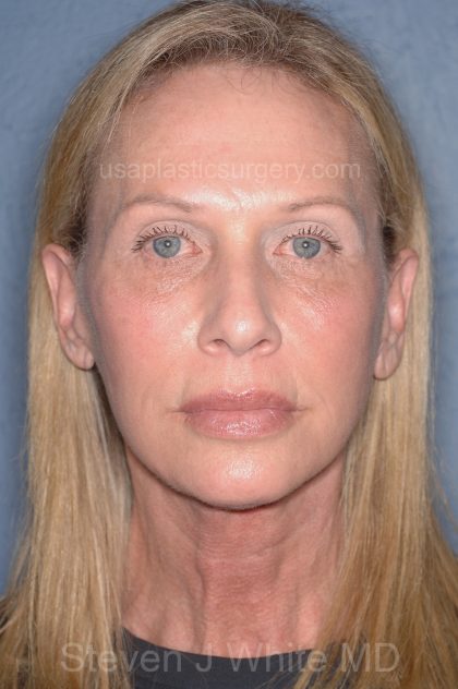 Upper & Lower Facelift - Brow Lift & Face/Neck Lift Before & After Patient #8026