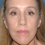 Upper & Lower Facelift - Brow Lift & Face/Neck Lift Before & After Patient #8031
