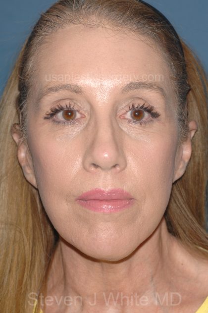 Upper & Lower Facelift - Brow Lift & Face/Neck Lift Before & After Patient #8031