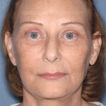 Upper & Lower Facelift - Brow Lift & Face/Neck Lift Before & After Patient #8032