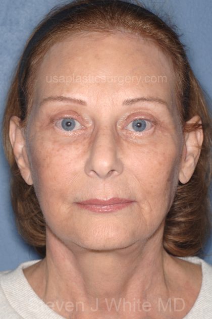 Upper & Lower Facelift - Brow Lift & Face/Neck Lift Before & After Patient #8032