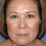 Upper & Lower Facelift - Brow Lift & Face/Neck Lift Before & After Patient #8033