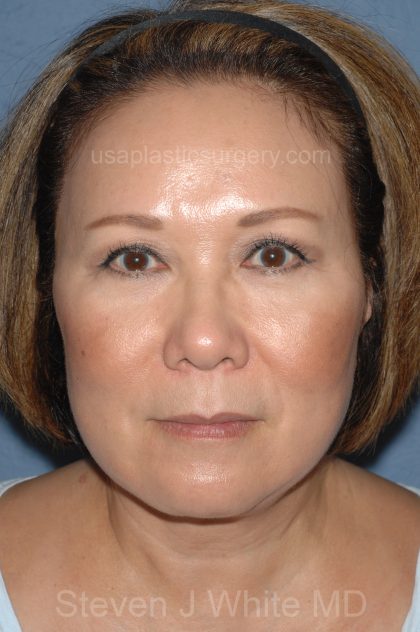 Upper & Lower Facelift - Brow Lift & Face/Neck Lift Before & After Patient #8033