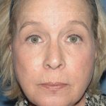 Upper & Lower Facelift - Brow Lift & Face/Neck Lift Before & After Patient #8034