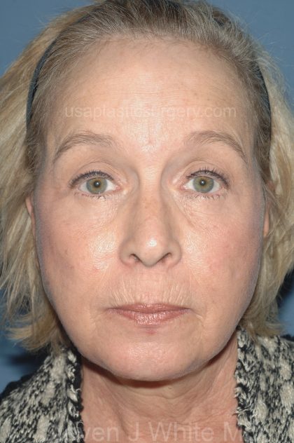 Upper & Lower Facelift - Brow Lift & Face/Neck Lift Before & After Patient #8034