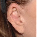 Facelift - Scar Before & After Patient #8228