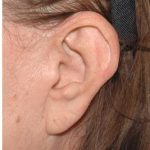 Facelift - Scar Before & After Patient #8228