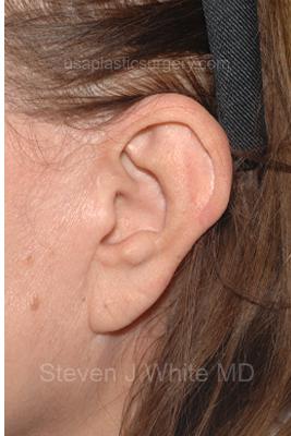 Facelift - Scar Before & After Patient #8228