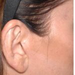 Facelift - Scar Before & After Patient #8249