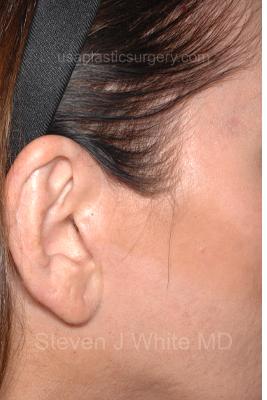 Facelift - Scar Before & After Patient #8249