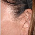 Facelift - Scar Before & After Patient #8249