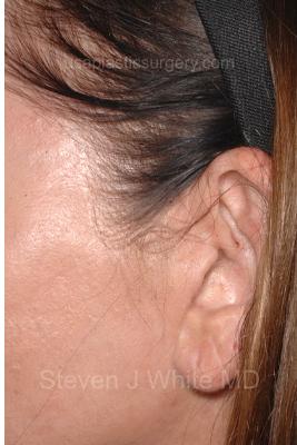 Facelift - Scar Before & After Patient #8249