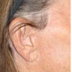 Facelift - Scar Before & After Patient #8250