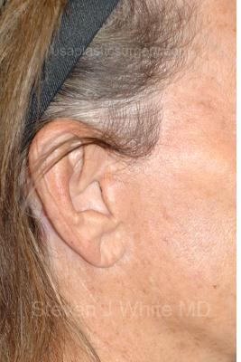 Facelift - Scar Before & After Patient #8250