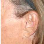 Facelift - Scar Before & After Patient #8250