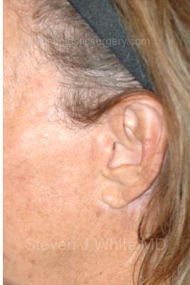 Facelift - Scar Before & After Patient #8250