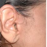 Facelift - Scar Before & After Patient #8251
