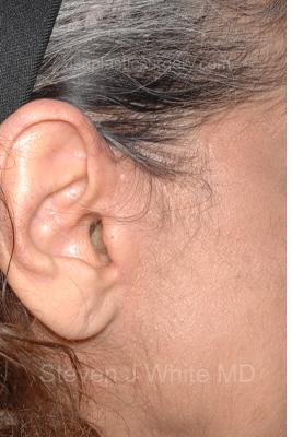 Facelift - Scar Before & After Patient #8251