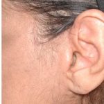 Facelift - Scar Before & After Patient #8251