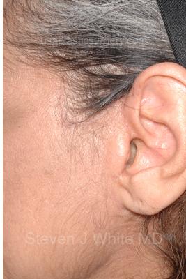 Facelift - Scar Before & After Patient #8251