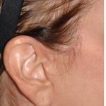 Facelift - Scar Before & After Patient #8252