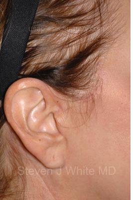 Facelift - Scar Before & After Patient #8252