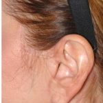 Facelift - Scar Before & After Patient #8252