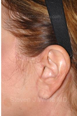 Facelift - Scar Before & After Patient #8252