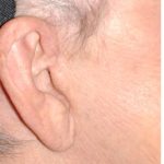 Facelift - Scar Before & After Patient #8253