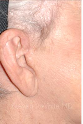 Facelift - Scar Before & After Patient #8253