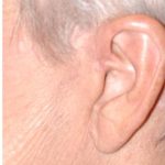 Facelift - Scar Before & After Patient #8253