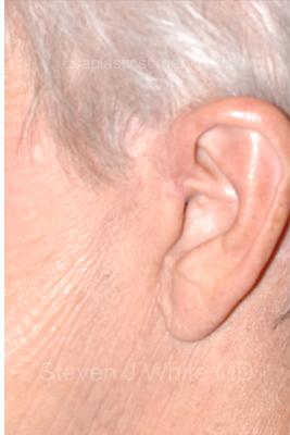 Facelift - Scar Before & After Patient #8253