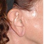 Facelift - Scar Before & After Patient #8254