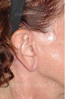 Facelift - Scar Before & After Patient #8254