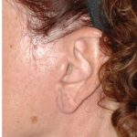 Facelift - Scar Before & After Patient #8254