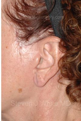 Facelift - Scar Before & After Patient #8254