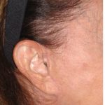 Facelift - Scar Before & After Patient #8255