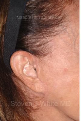 Facelift - Scar Before & After Patient #8255