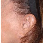 Facelift - Scar Before & After Patient #8255
