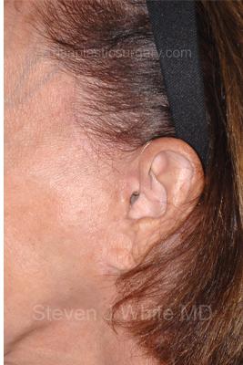 Facelift - Scar Before & After Patient #8255