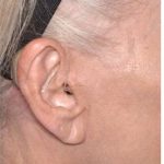 Facelift - Scar Before & After Patient #8256