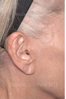 Facelift - Scar Before & After Patient #8256