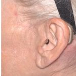Facelift - Scar Before & After Patient #8256