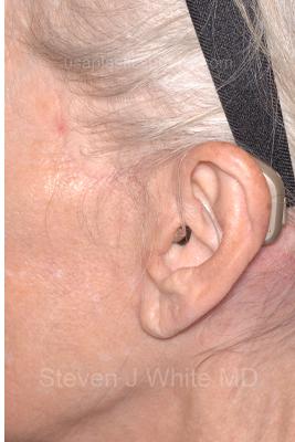 Facelift - Scar Before & After Patient #8256