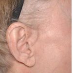 Facelift - Scar Before & After Patient #8169