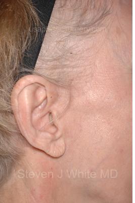 Facelift - Scar Before & After Patient #8169