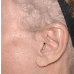 Facelift - Scar Before & After Patient #8169