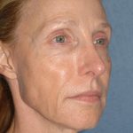 Upper & Lower Facelift - Brow Lift & Face/Neck Lift Before & After Patient #8027