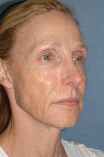 Upper & Lower Facelift - Brow Lift & Face/Neck Lift Before & After Patient #8027
