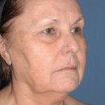Upper & Lower Facelift - Brow Lift & Face/Neck Lift Before & After Patient #8301